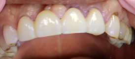 Bridge case after