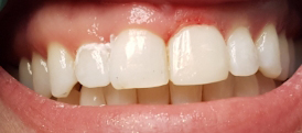 Compositve Veneers after