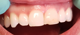 Compositve Veneers before