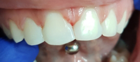 Diastema Closures after