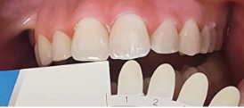 Whitening case after