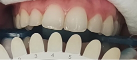 Whitening case before